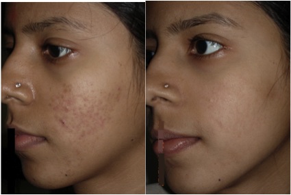 acne-scars-removed-ultra-ance-clear
